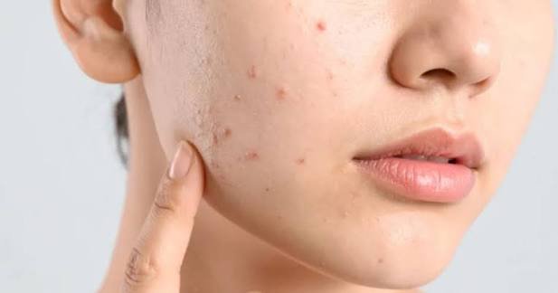 reduce acne naturally